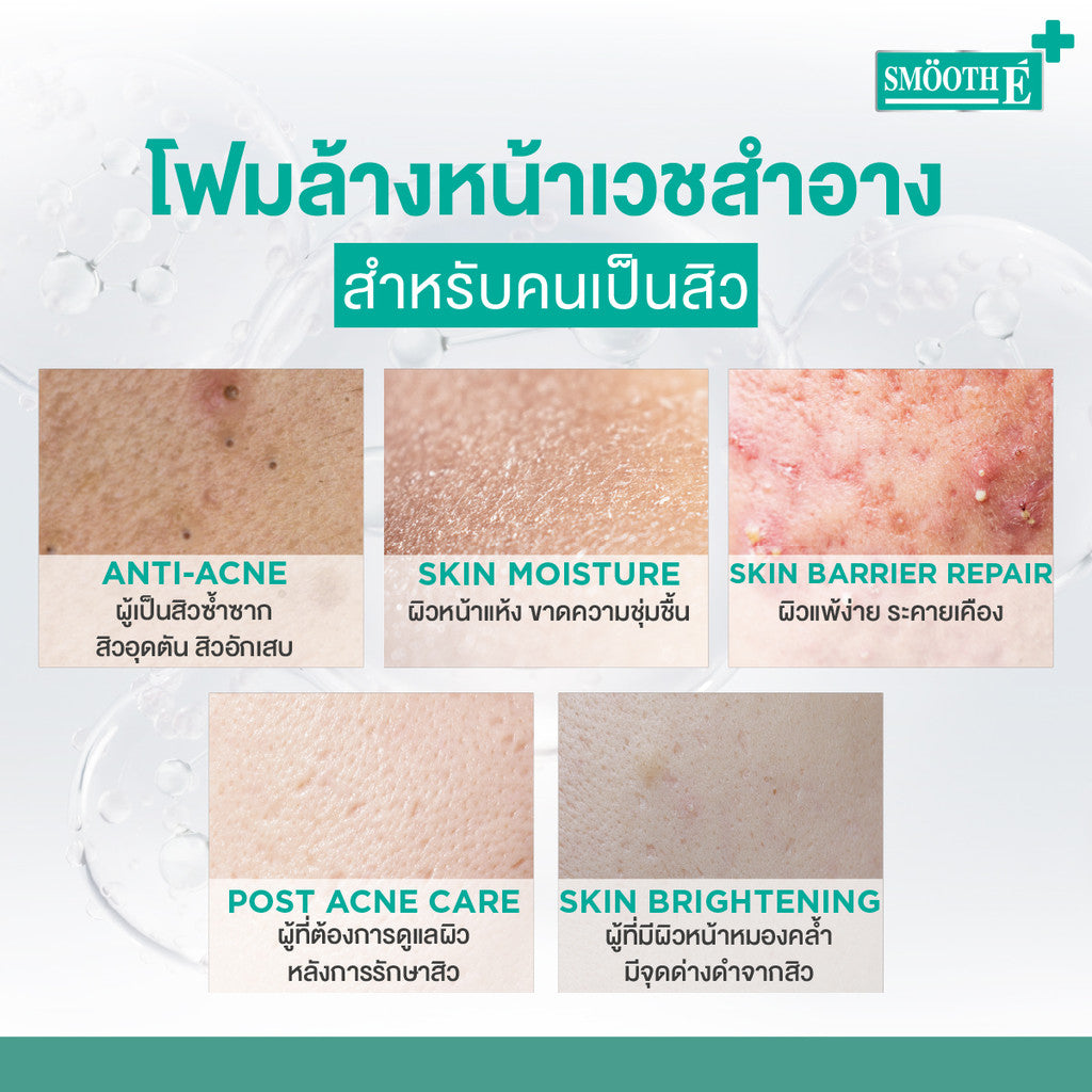 Smooth E Acne-5 Whitening Set