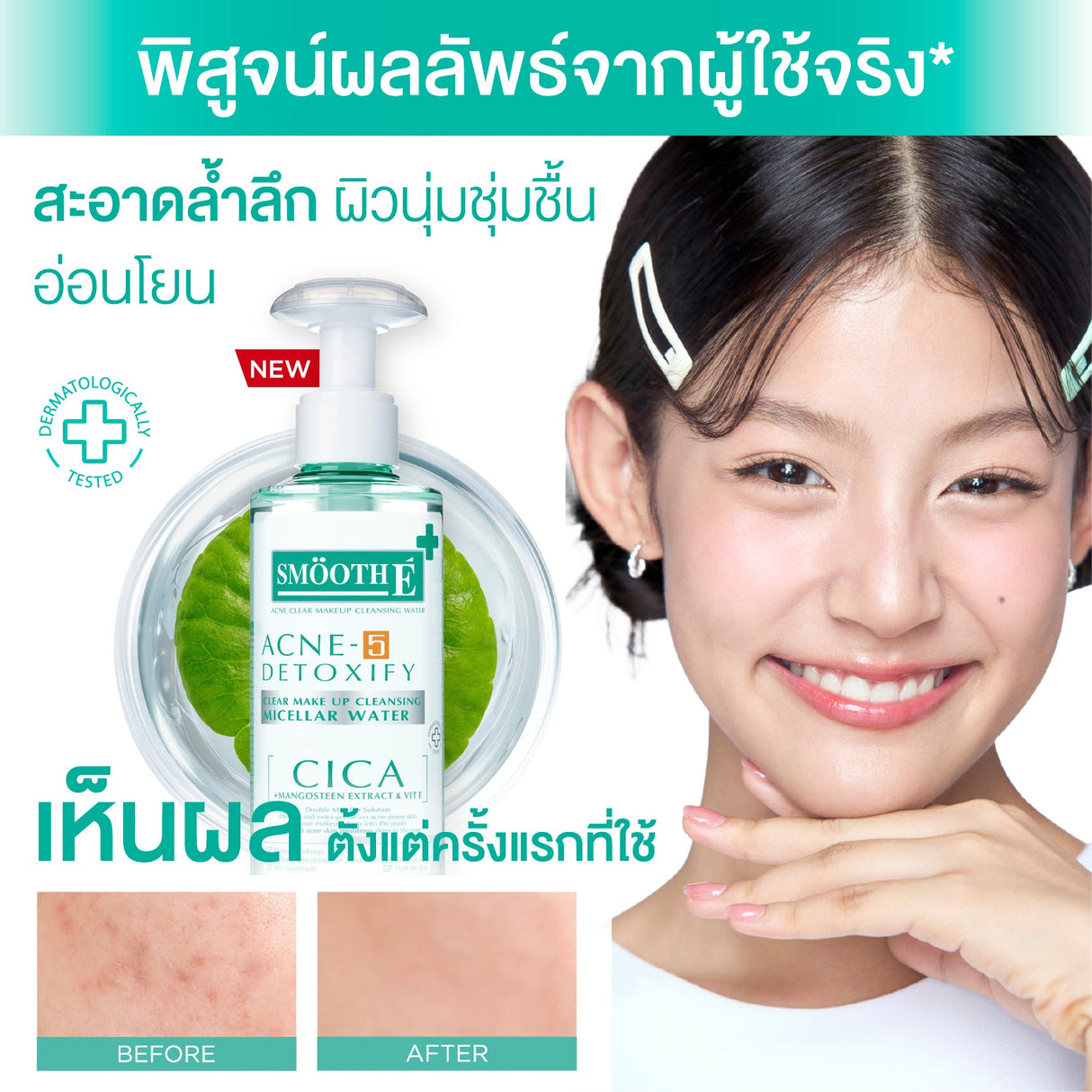 Smooth E Acne-5 Clear Makeup Cleansing Water