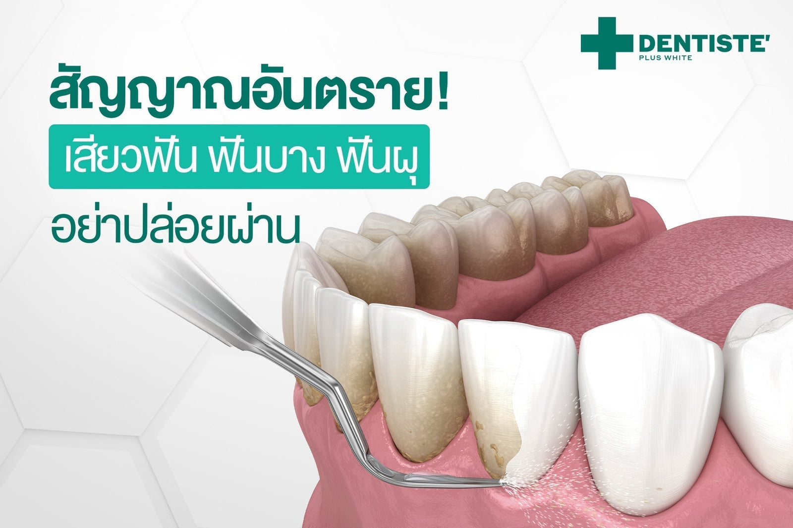 ฟันบาง เคลือบฟันเสื่อม… ปัญหาที่ซ่อมได้ด้วยนวัตกรรม Biomin® F